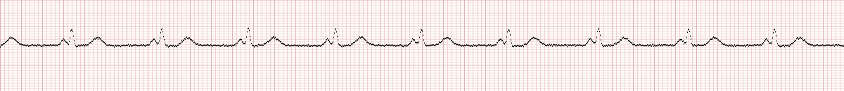 Animated Lead II EKG rhythm strip for question 1