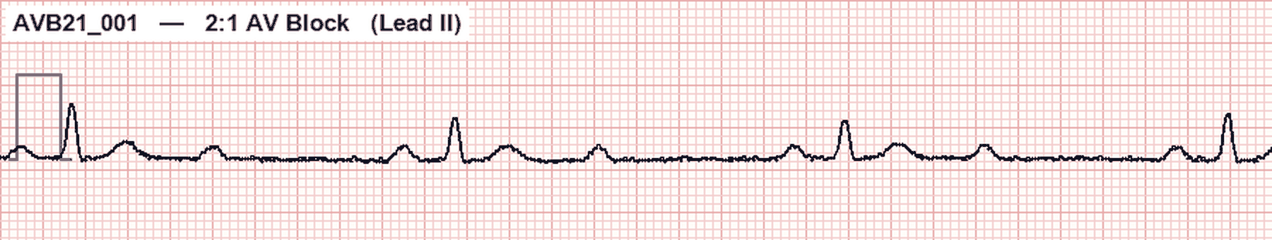 Simulated Lead II ECG showing 2 to 1 AV block with two P waves for every QRS complex