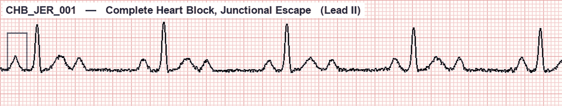 Simulated Lead II ECG showing complete heart block with independent P waves and QRS complexes and a junctional escape rhythm