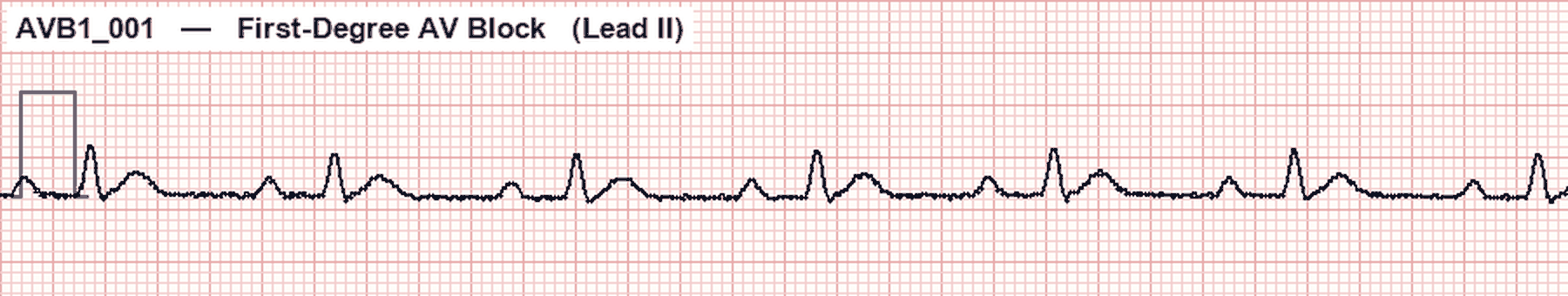 Simulated Lead II ECG showing first-degree AV block with a prolonged constant PR interval and one QRS after every P wave
