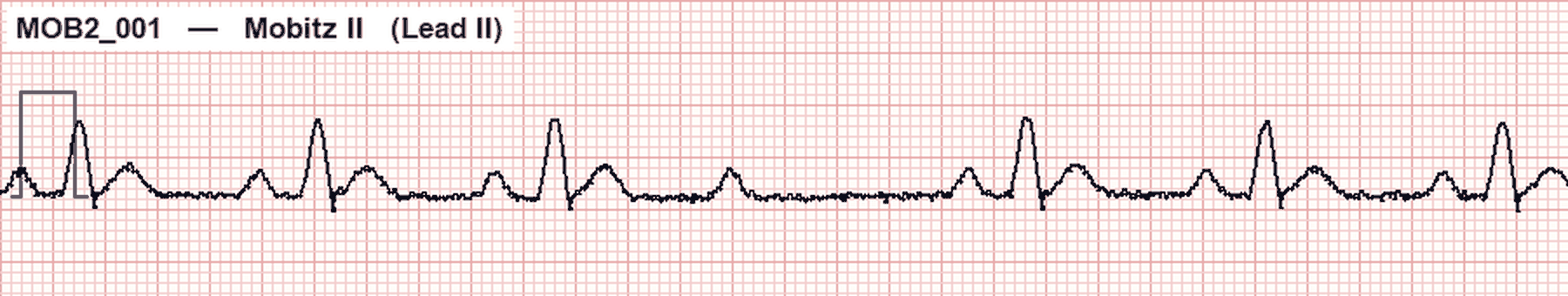 Simulated Lead II ECG showing Mobitz II with constant PR intervals on conducted beats and an intermittent nonconducted P wave
