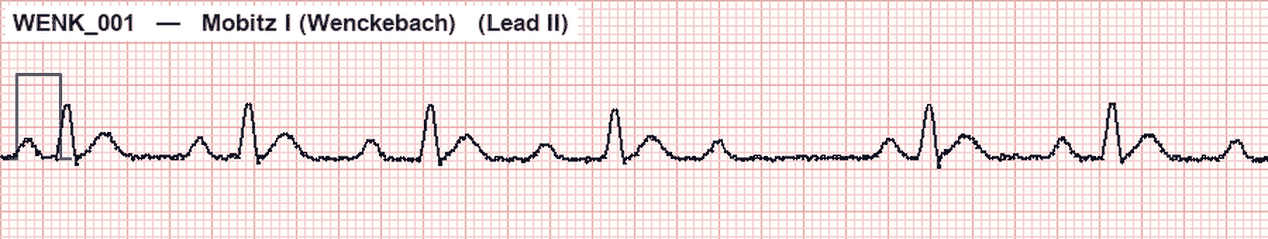 Simulated Lead II ECG showing Mobitz I Wenckebach with changing PR intervals before a nonconducted P wave